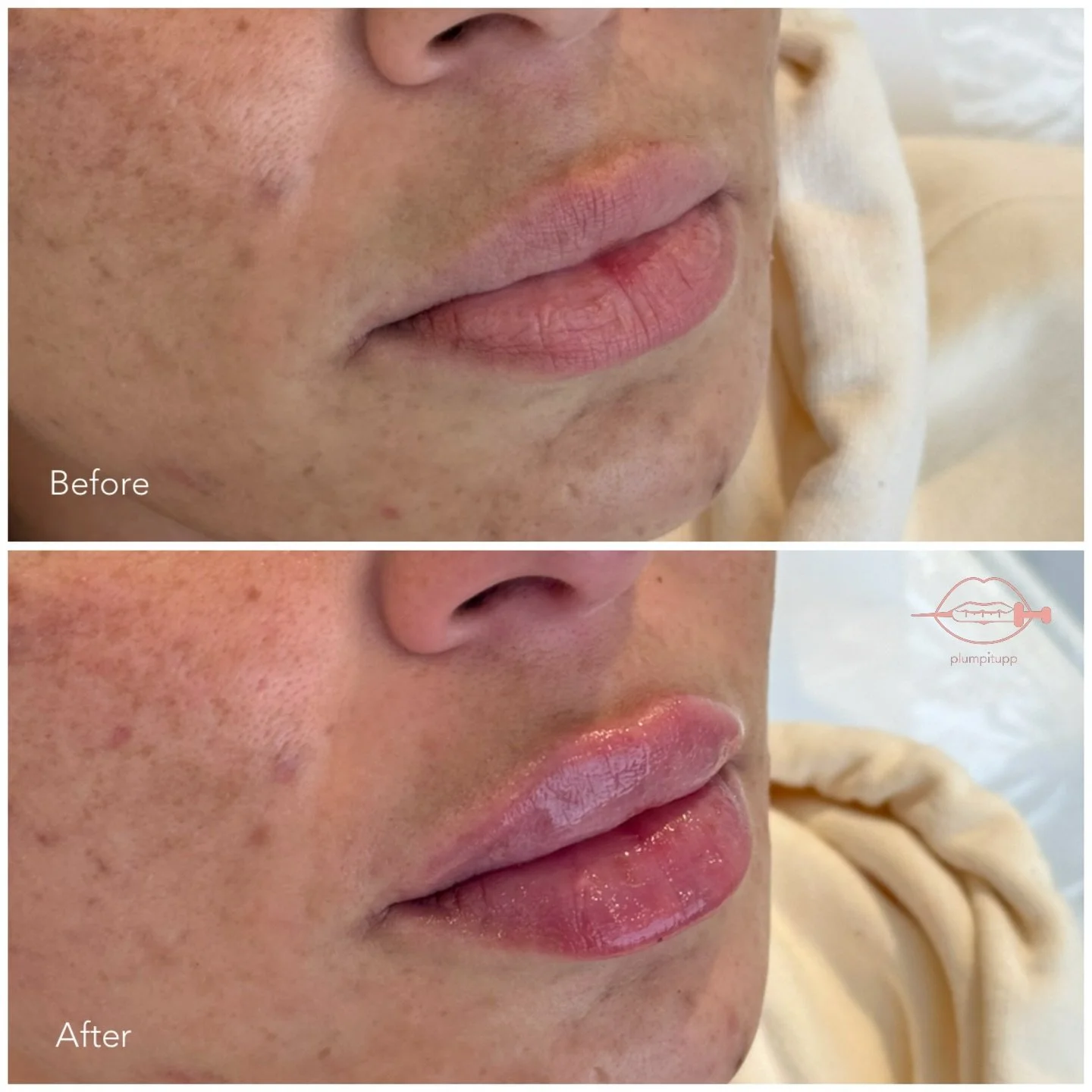 Perfectly Plump ✨💉

Full Lip Enhancement for our beautiful client! Our goal was natural lips, with soft definition, and maximum hydration. 

Zero edits. Zero filters. Do you love our Plumpitupp lip filler results? 👀

Content is for educational purp