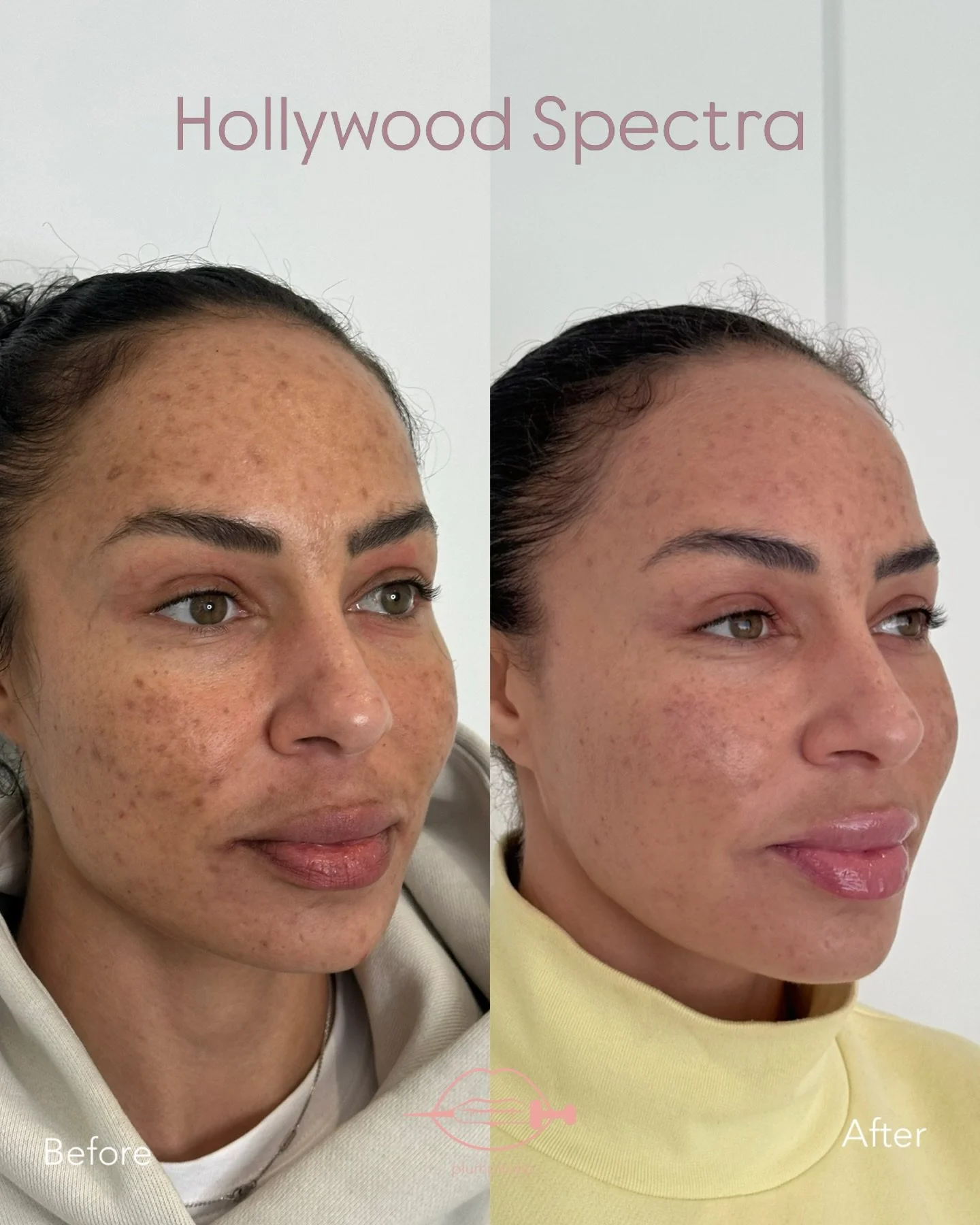 ✨ This is what happens when the right technology meets the right hands.

Meet one of our incredible clients - she came to us with acne scarring that had been affecting her confidence for years. She had tried everything. Creams, facials, chemical peel