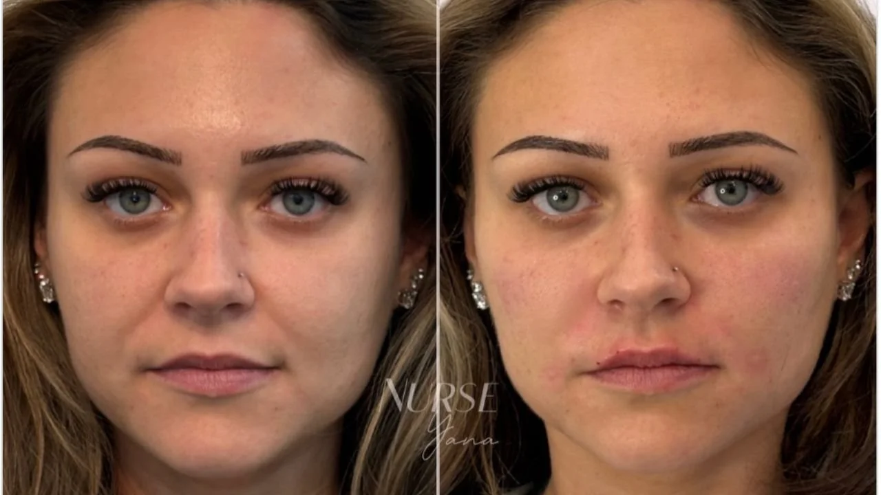 Nasolabial Fold Filler: 5 Different Options Compared Honestly