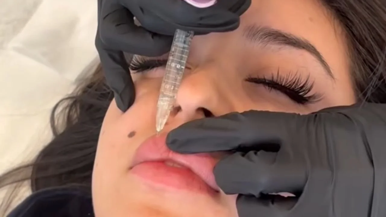 Marionette Lines Filler: Why People Have Frown Lines and 4 Ways to Fix It