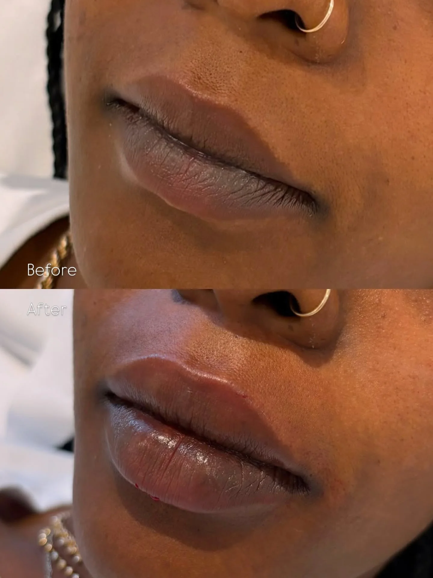 Perfectly pouty &amp; plump 😍

Full Lip Enhancement for our first time filler client. HA dermal filler can be used for hydrating, smoothing, and shaping to give your lips a more defined and youthful appearance! 

Content is for educational purposes 