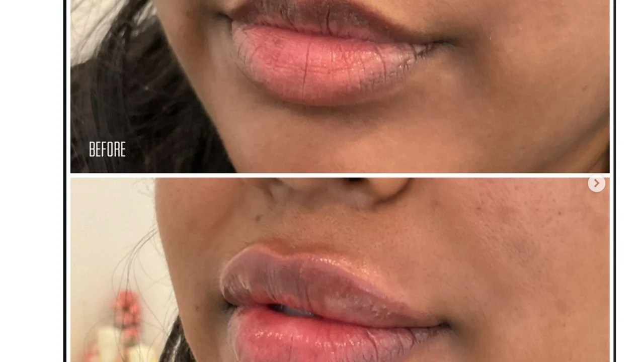 Lip Flip vs. Lip Filler: 5 Key Differences That Matter