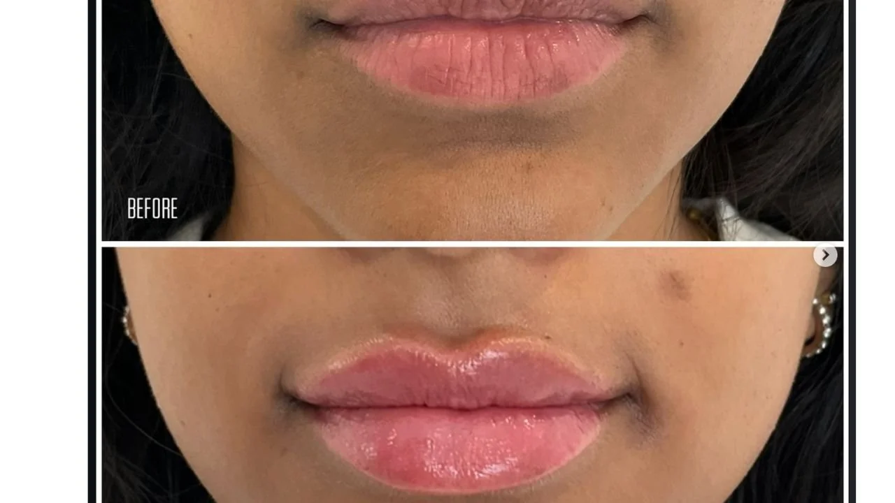 7 Lip Filler Swelling Stages Every Patient Should Know