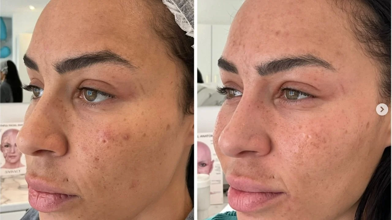 Melasma or Hyperpigmentation? 6 Proven Ways to Tell Apart