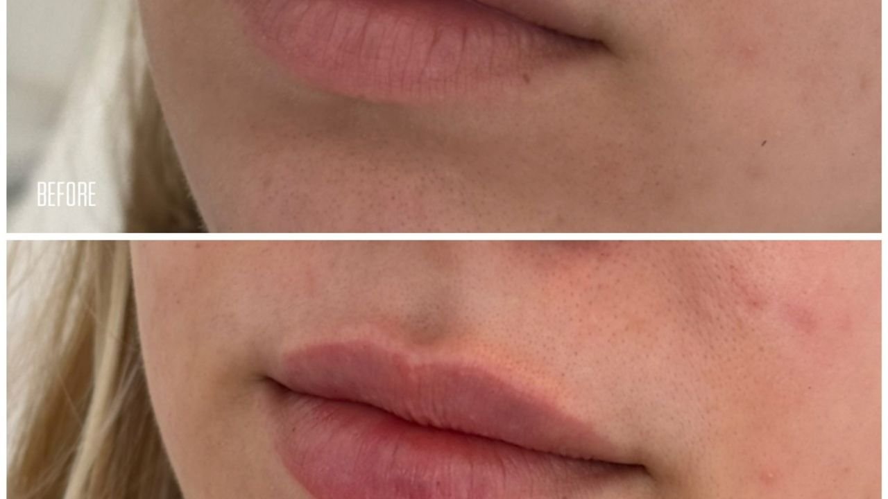 How Long Does a Lip Flip Last? What to Expect Week by Week