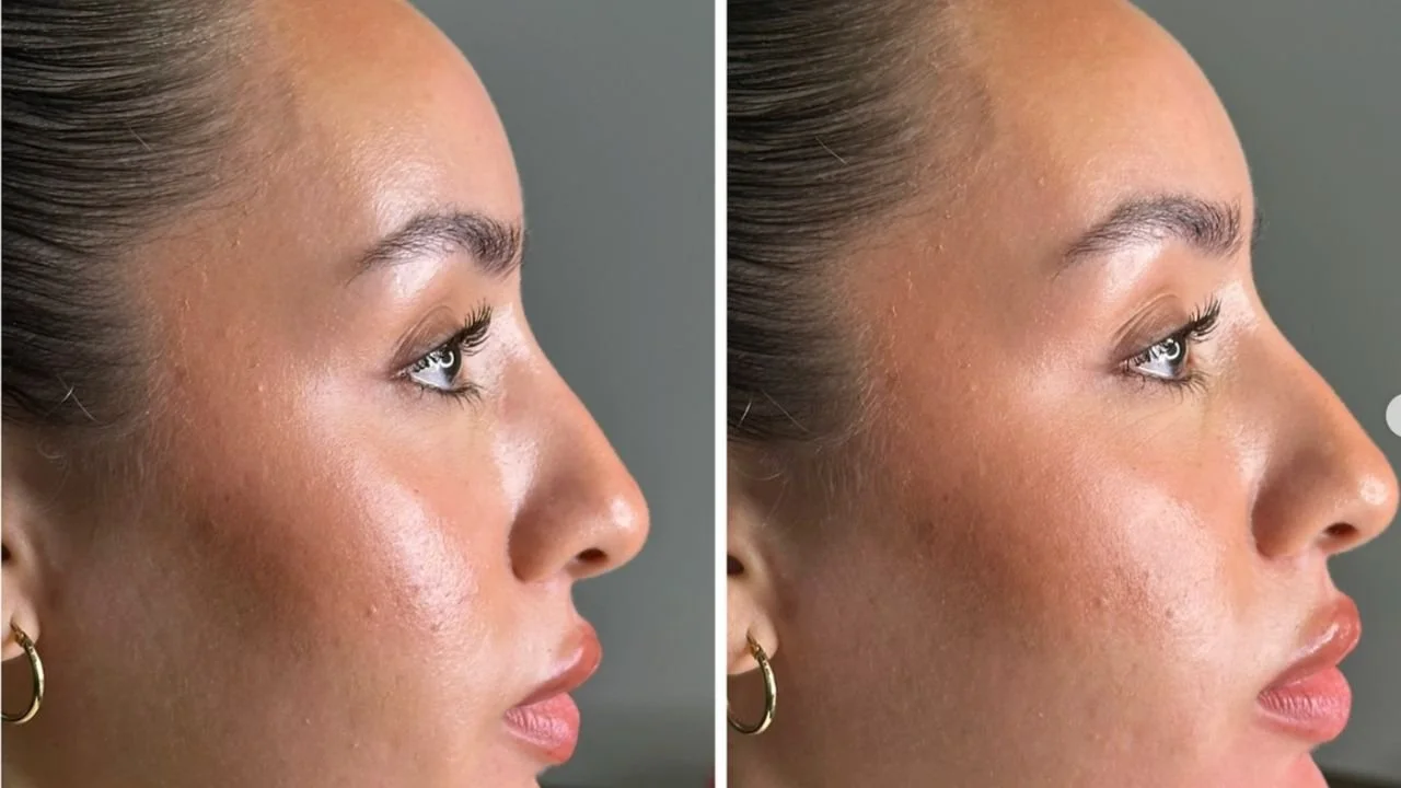 7 Facial Rejuvenation Treatments for Natural-Looking Results in Toronto