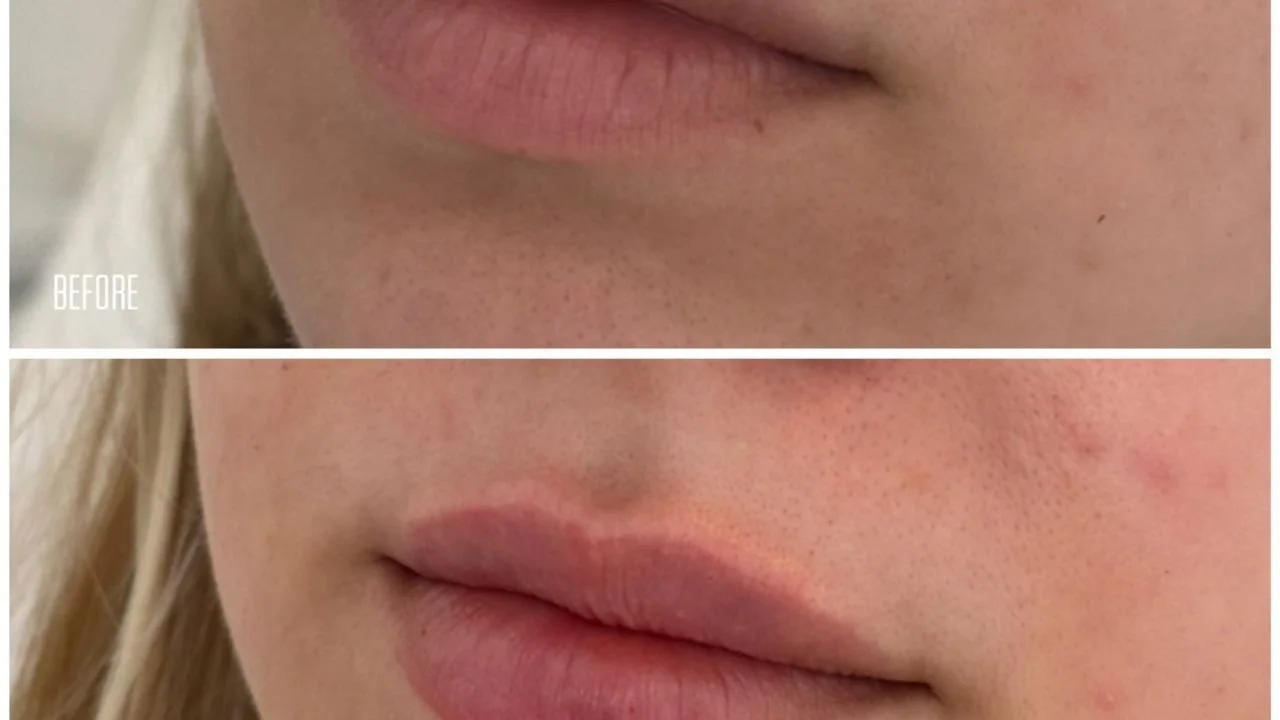 How Long Does a Lip Flip Last? What to Expect Week by Week