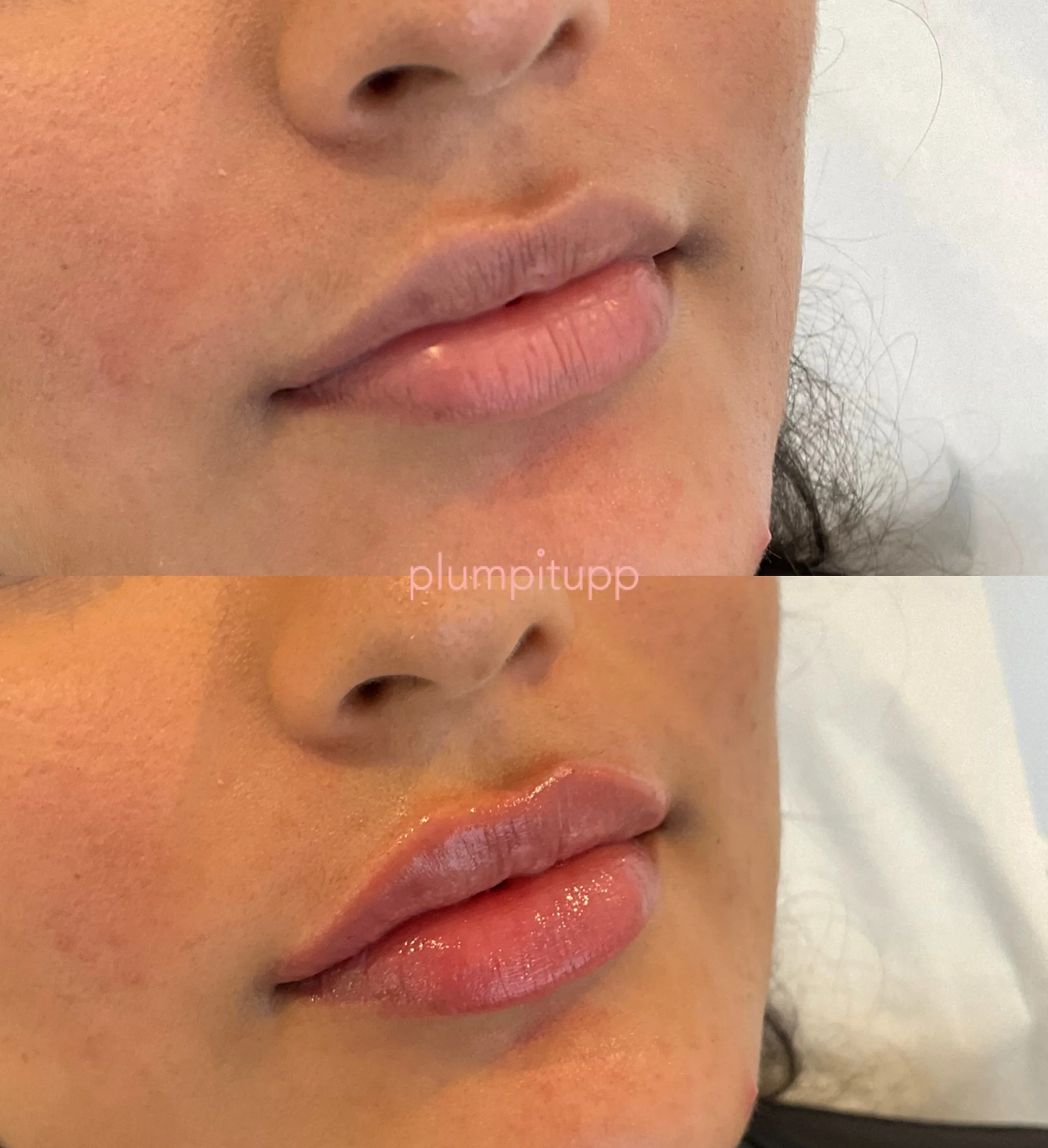 A subtle plump for some added definition, chef&rsquo;s kiss💋 

&bull;
&bull;
&bull;

Content is for educational purposes only. Individual results may vary. 

Plumpitupp is on a mission to help you look and feel your absolute best.

The @plumpitupp t