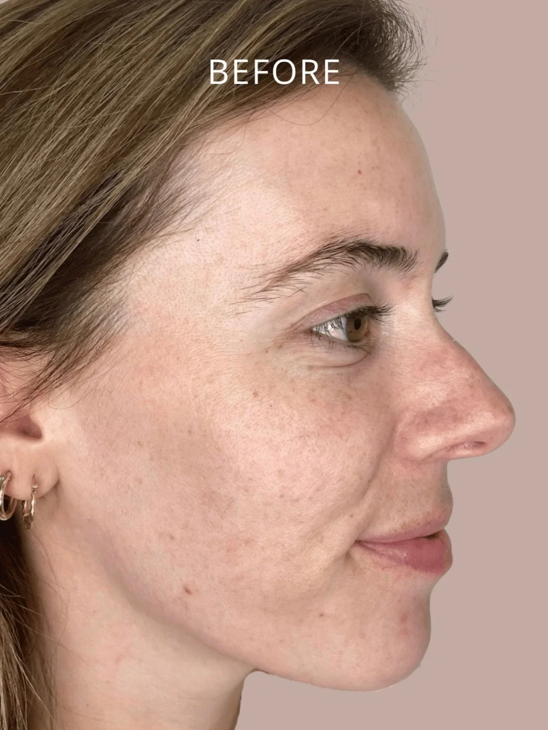 Facial Balancing done perfectly 💉✨

A holistic approach to facial anatomy and aging can give you incredible, natural looking results. Facial Balancing with Dermal Fillers is all about technique, product placement, assessment, and dosing.

We&rsquo;l