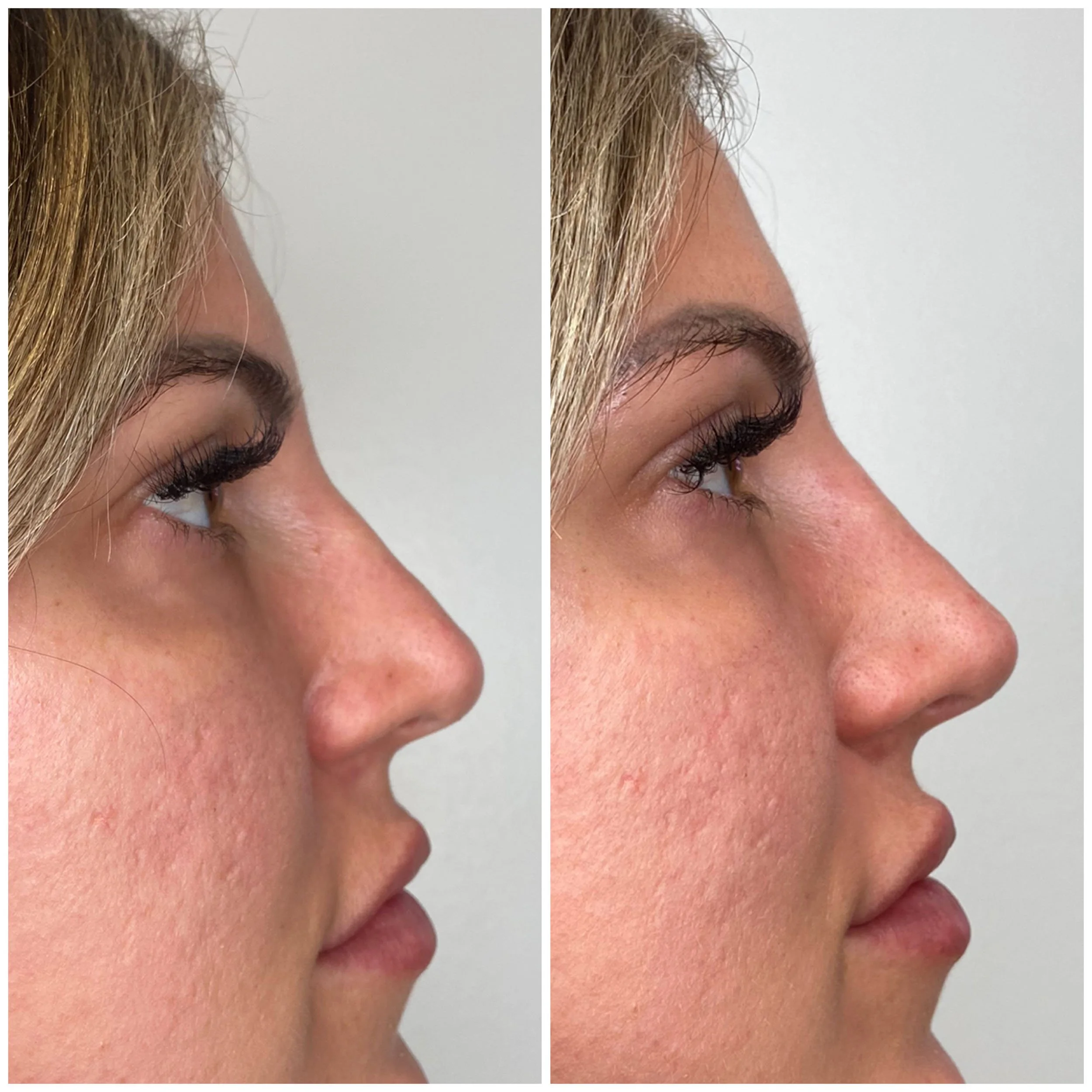 derma-fillers-31.jpg