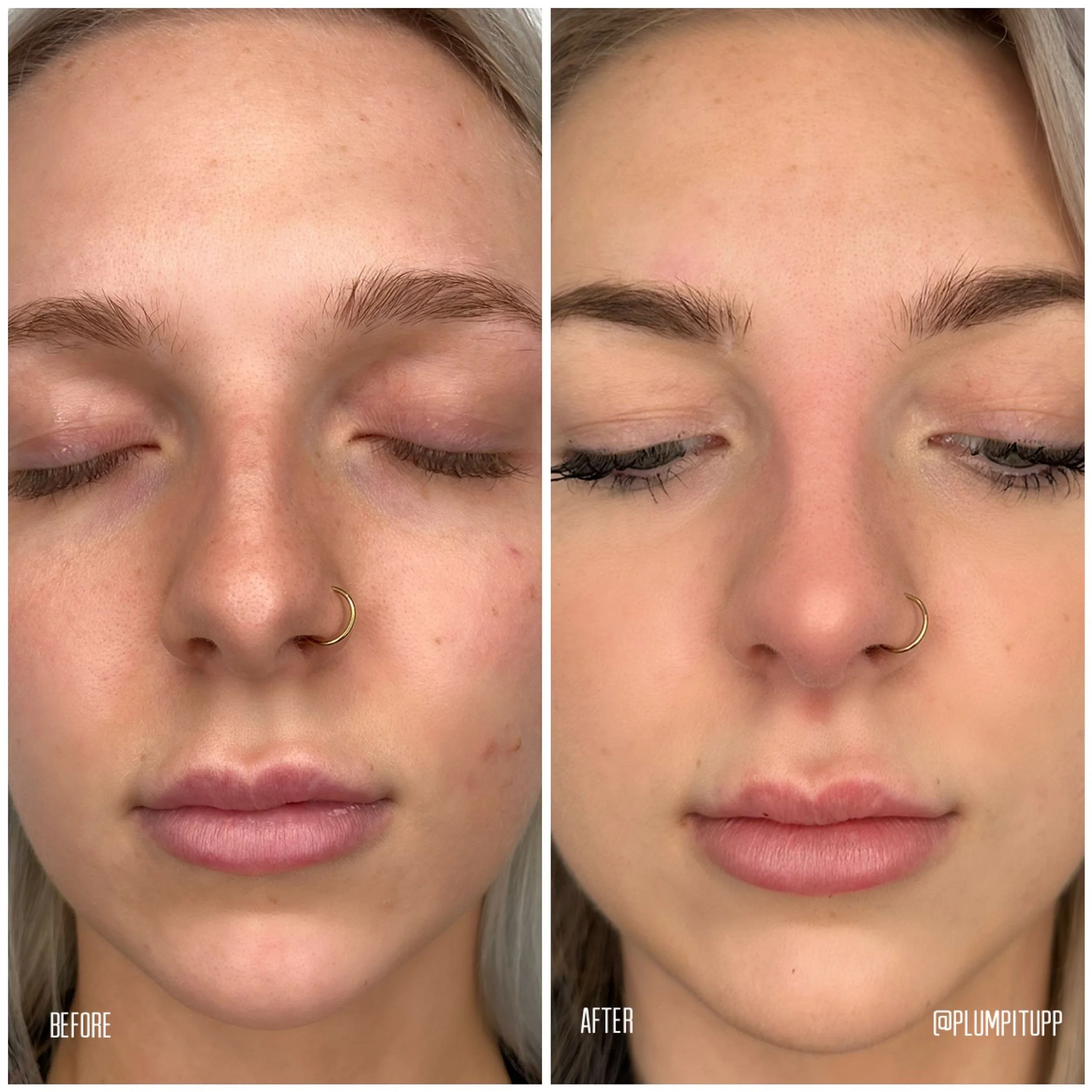 derma-fillers-25.jpg