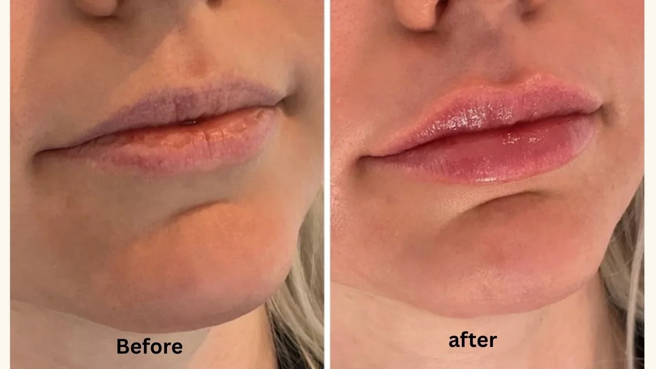 Lip filler before and after results