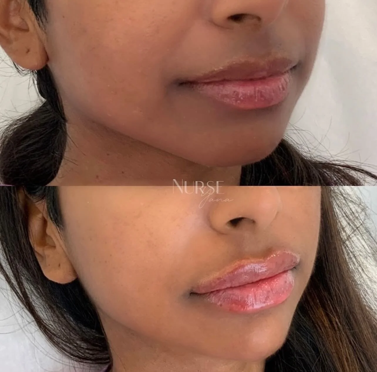 Before and after lip filler photo