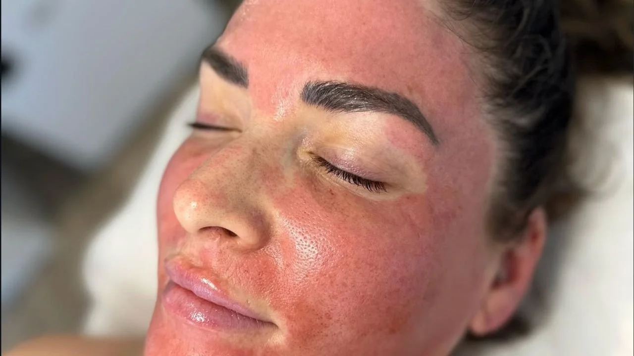 Close-up of woman's face during red chemical peel treatment