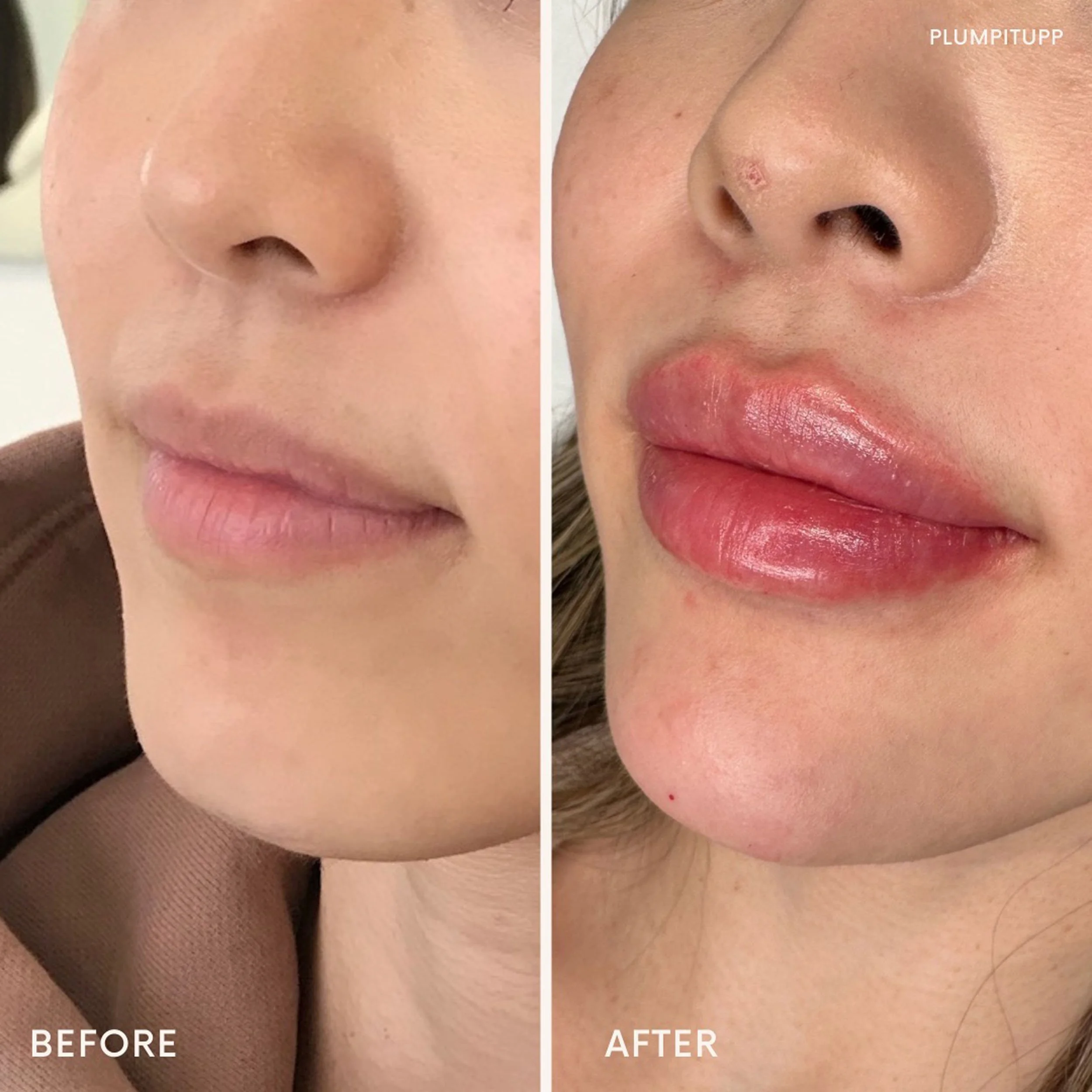 Hyaluronic Acid Injections Plump It Upp Medi Spa Toronto