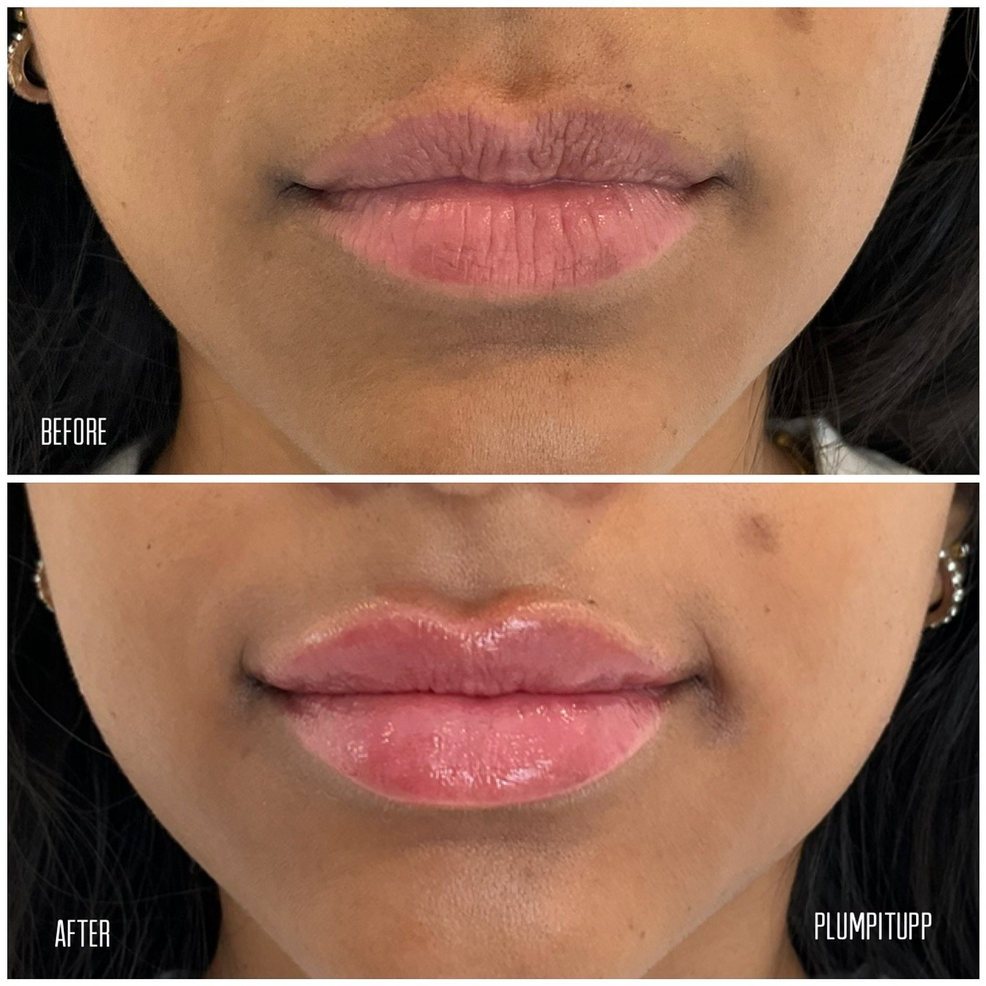 Subtle lip filler enhancement results
