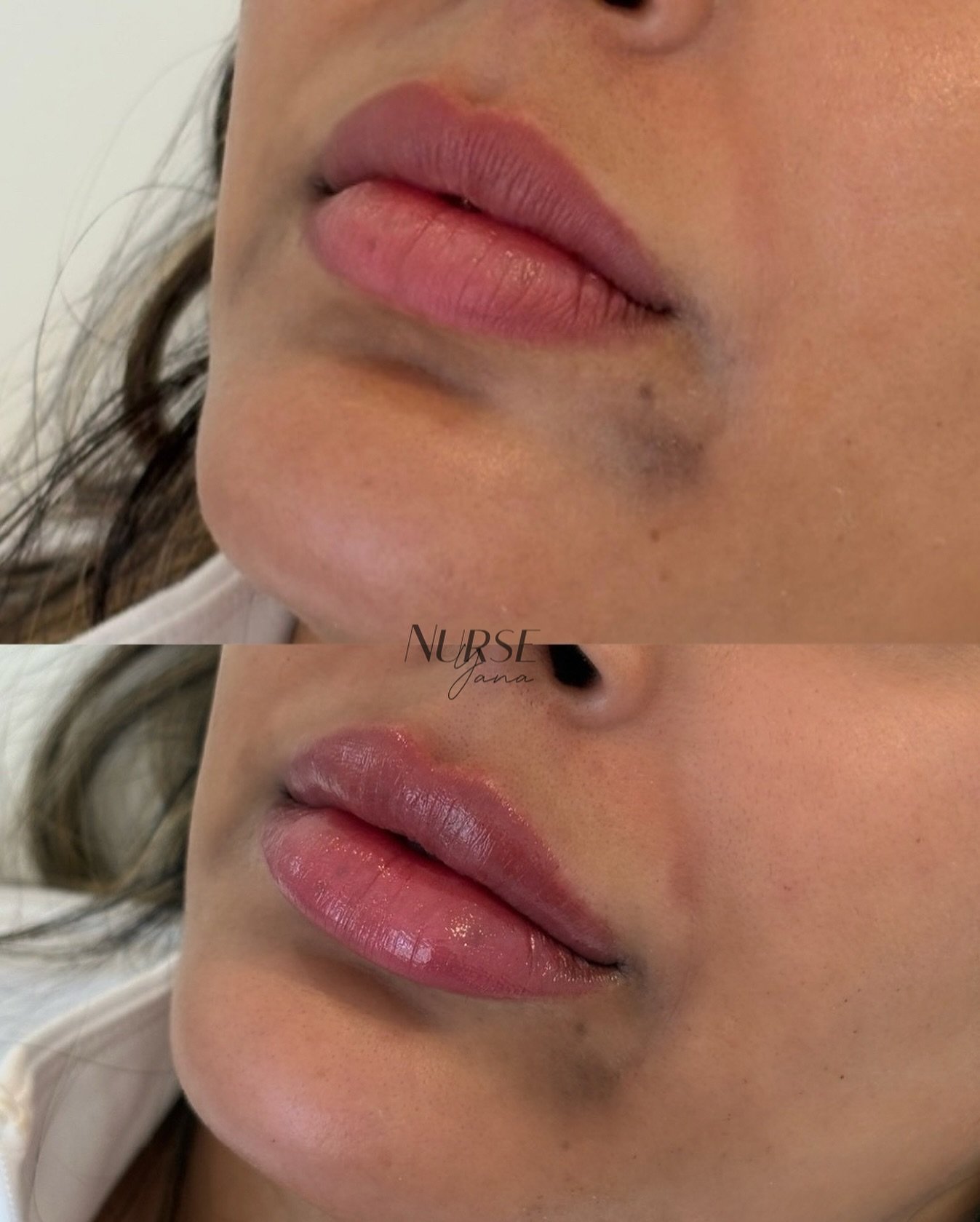Natural lip filler side profile results