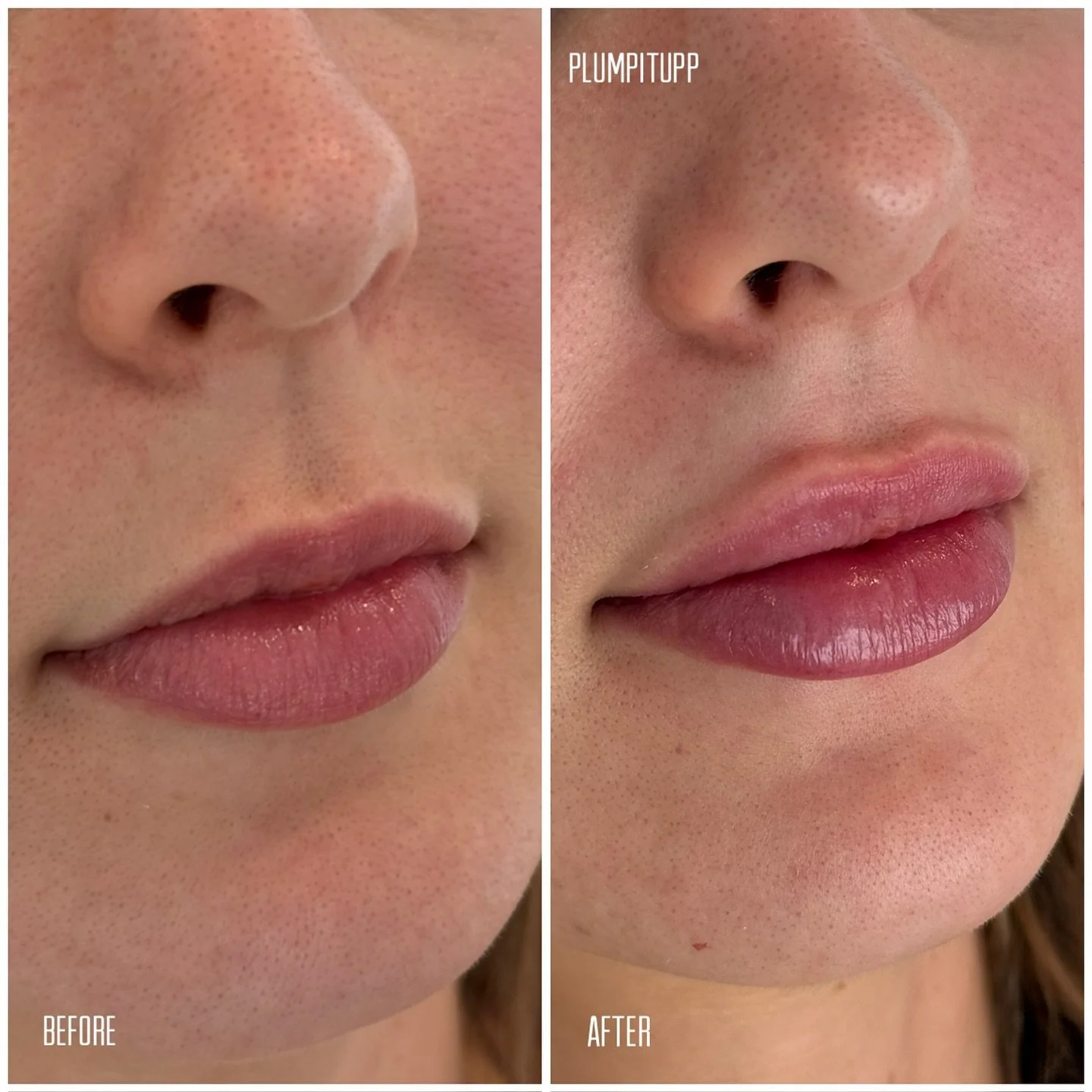 Natural lip filler before and after