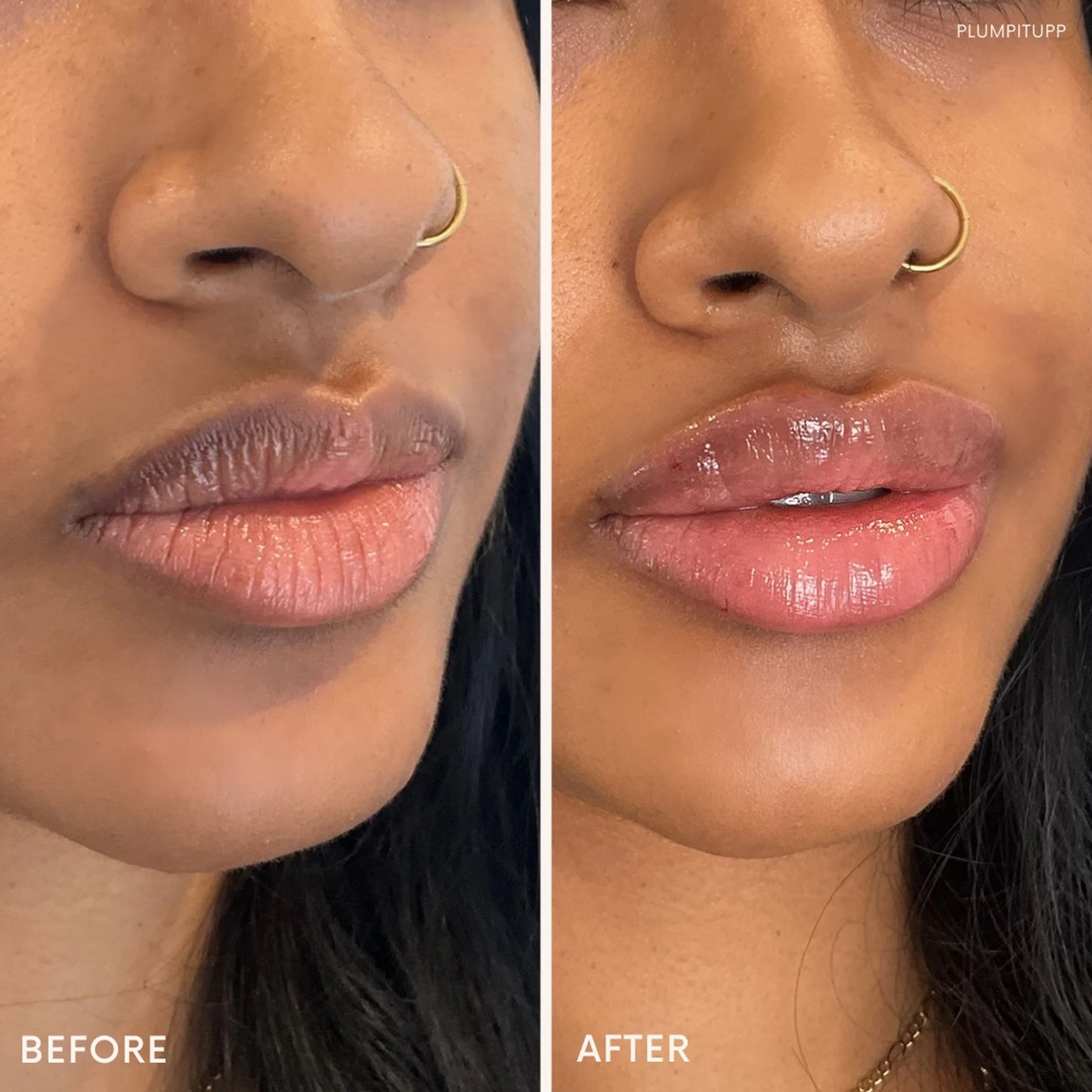 derma-fillers-22.jpg