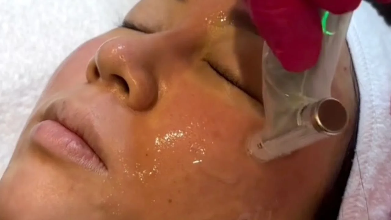 Microneedling treatment being applied to face with serum.