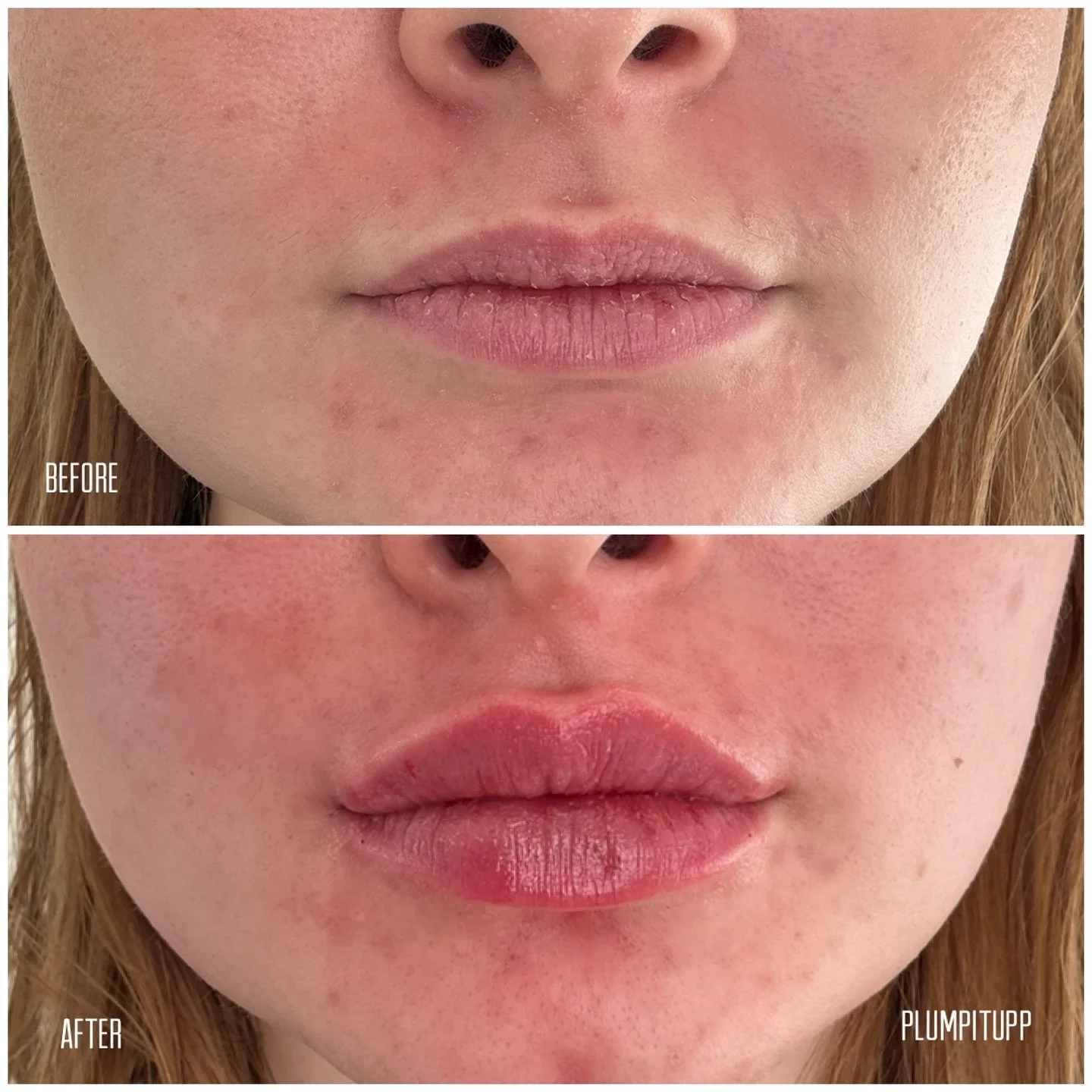 Front-facing lip filler before and after comparison
