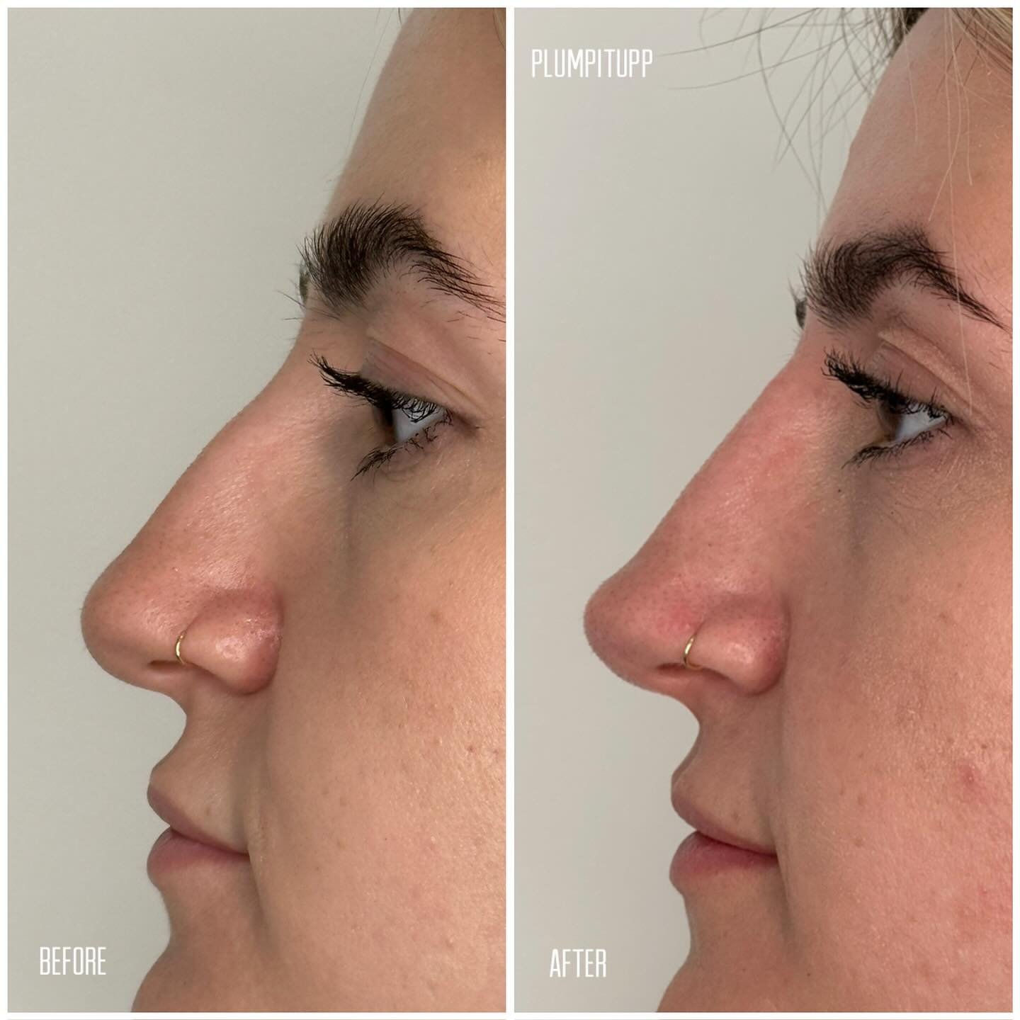 Before and after nose profile filler comparison