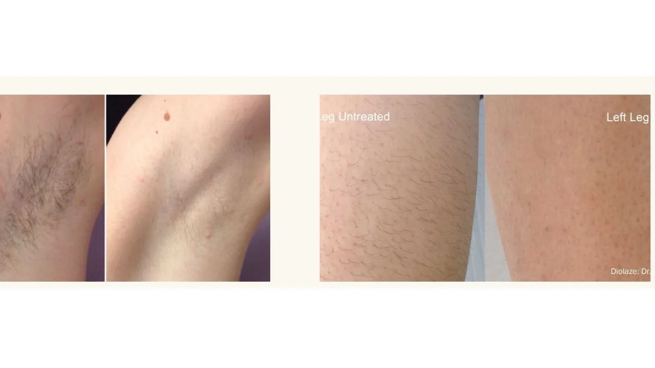 Before and after comparison photos showing laser hair removal results on the underarm and leg, with visibly reduced hair growth after treatment.