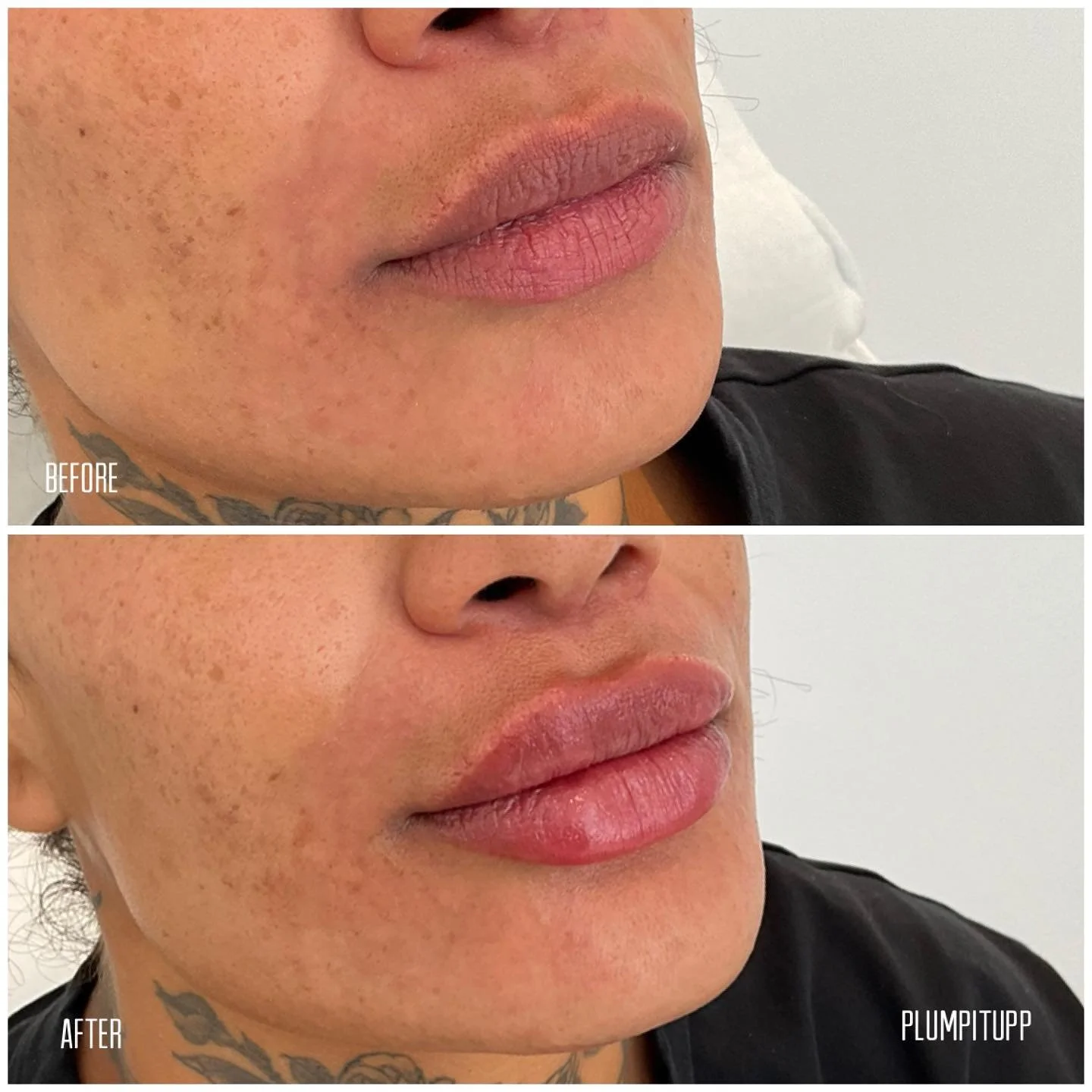 Before and after lip filler results, side profile view