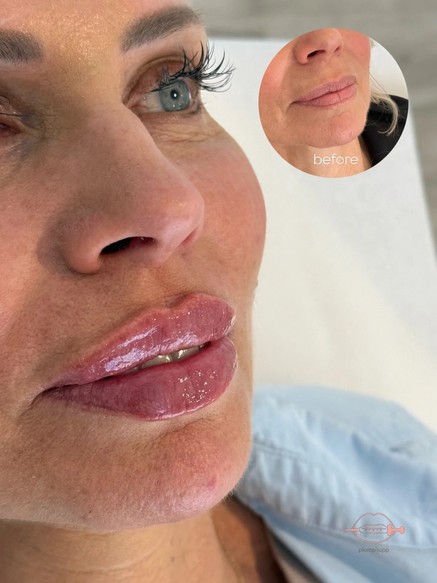 Plump It Upp lip filler before and after close-up.