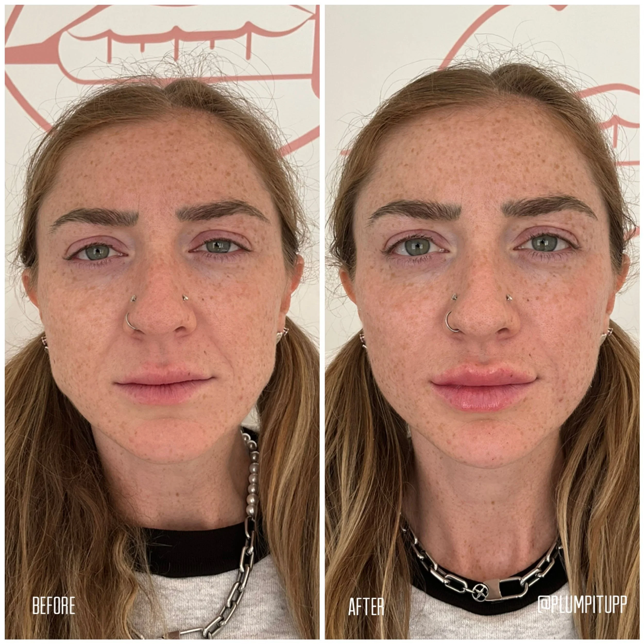 derma-fillers-9.jpg