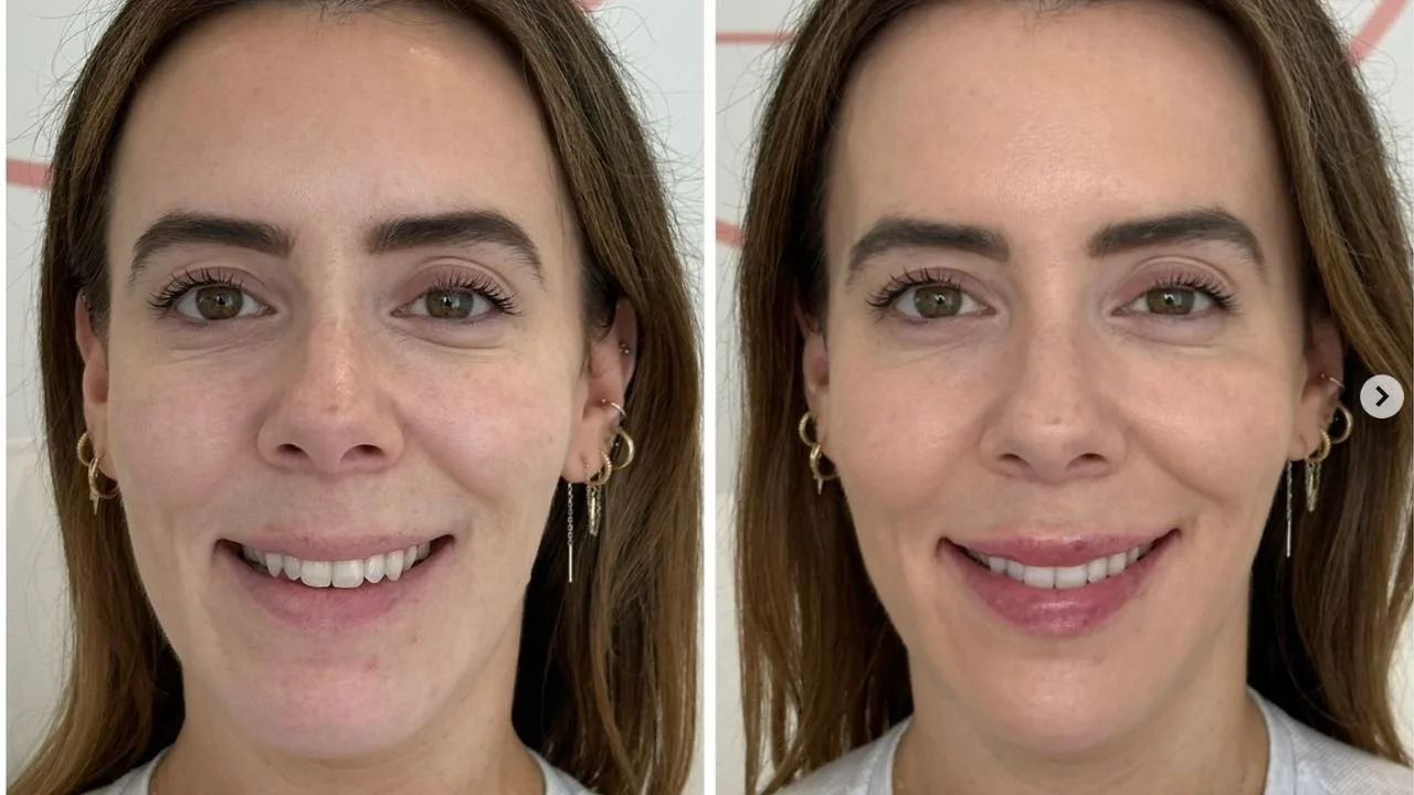 Before and after facial filler results at Plump It Upp