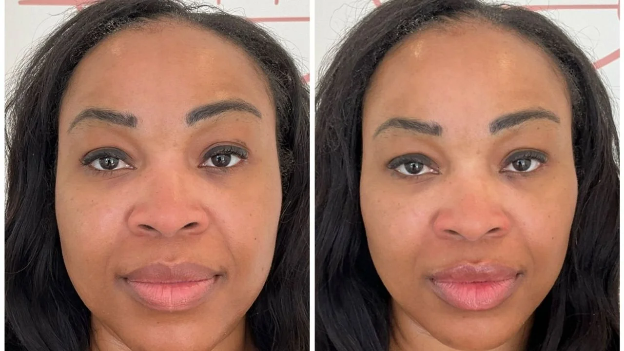 Before-and-after photos showing subtle jawline slimming following masseter Botox treatment.