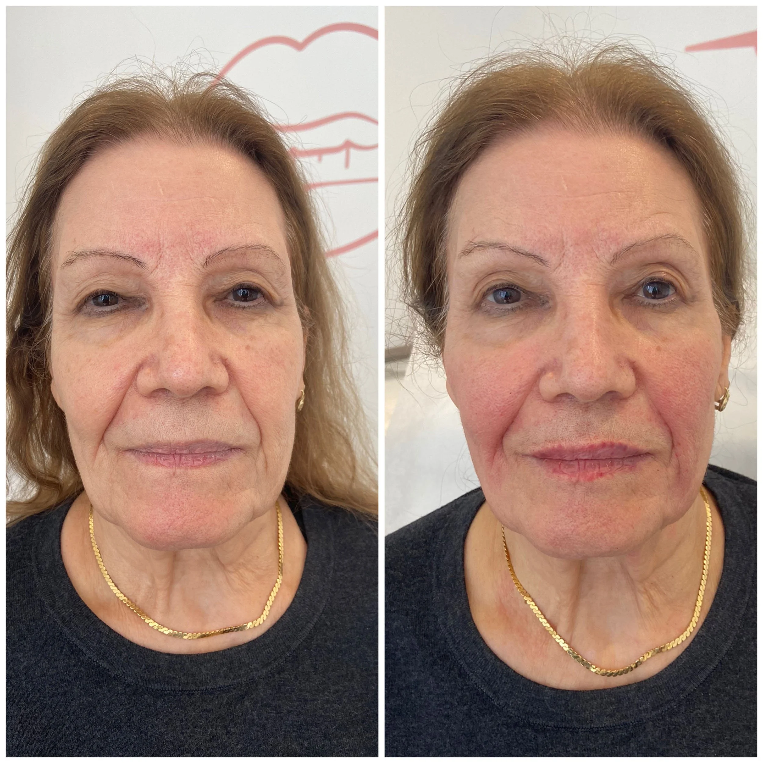 derma-fillers-5.jpg