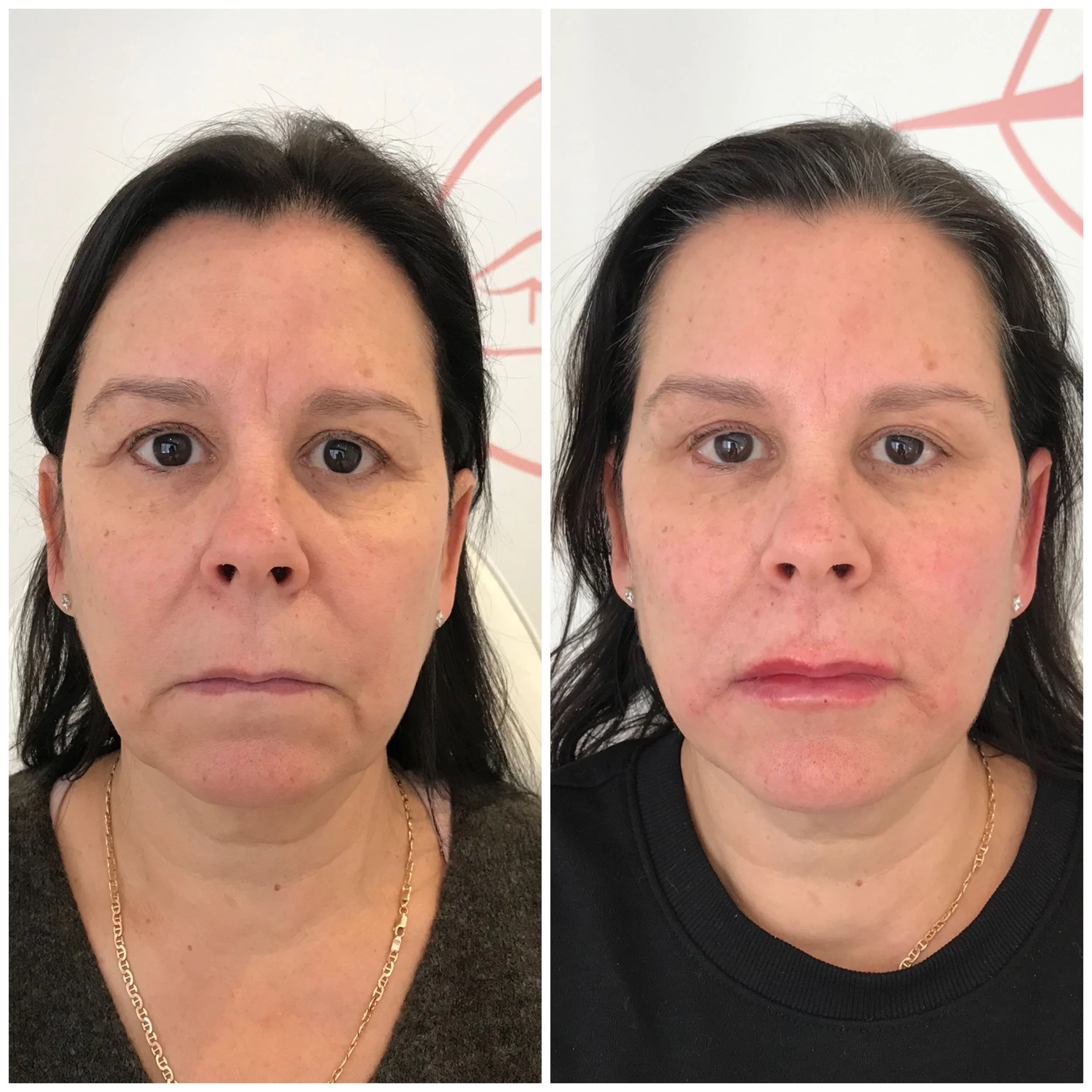 derma-fillers-4.jpg