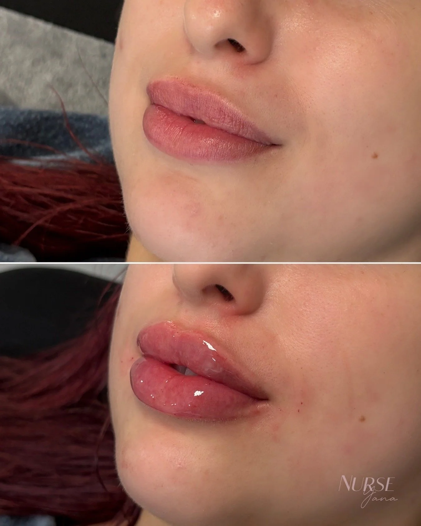 Nurse Yana natural lip filler before and after result.