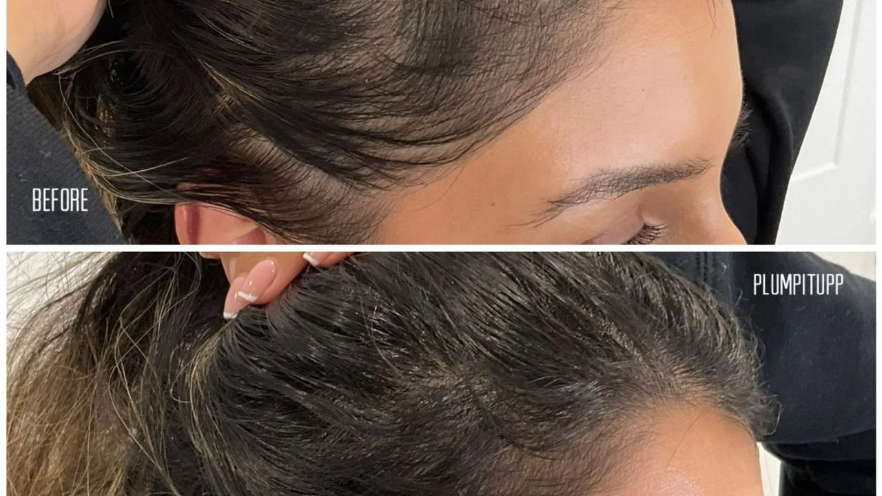 PRP hair treatment before and after one month, showing improved hair density.