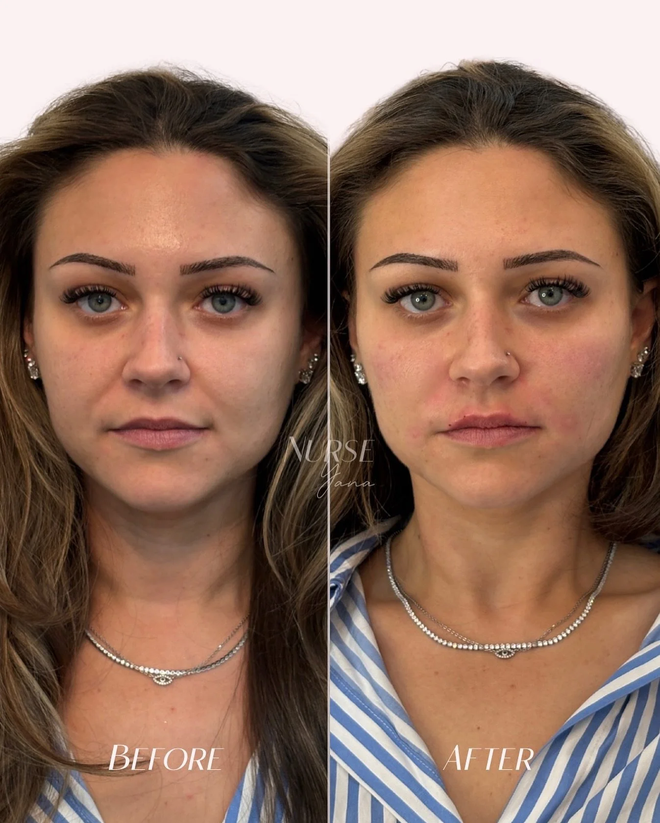 Before and after facial and lip filler treatment natural results comparison.