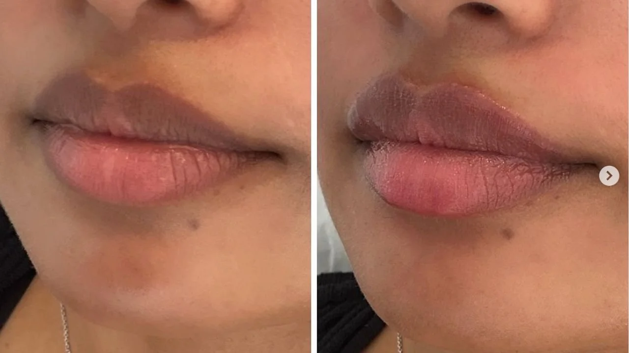 Plump It Upp natural lip filler before and after.
