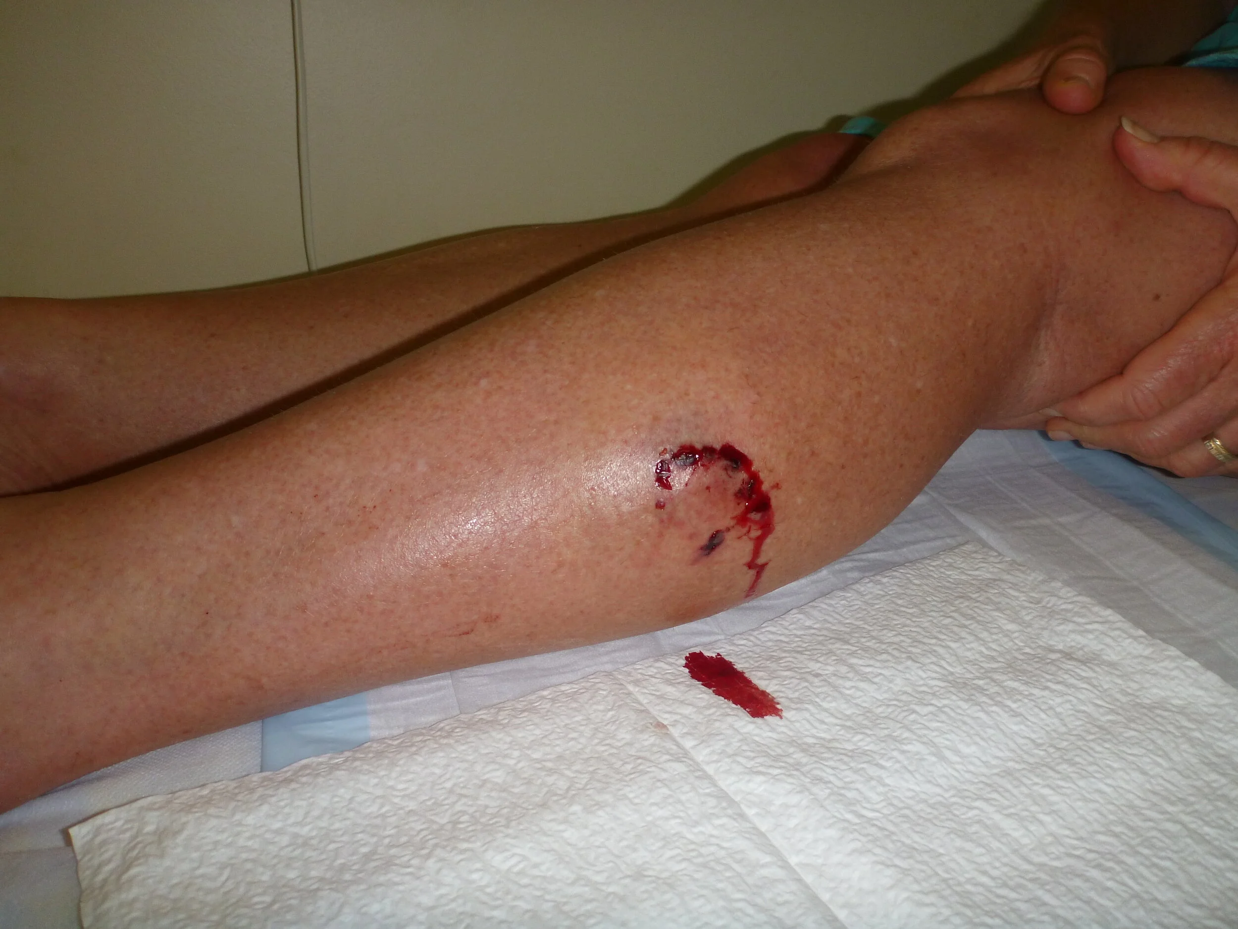 Dogbite WNBMC 29 OCT 2011 ah JWK 018 (2).JPG