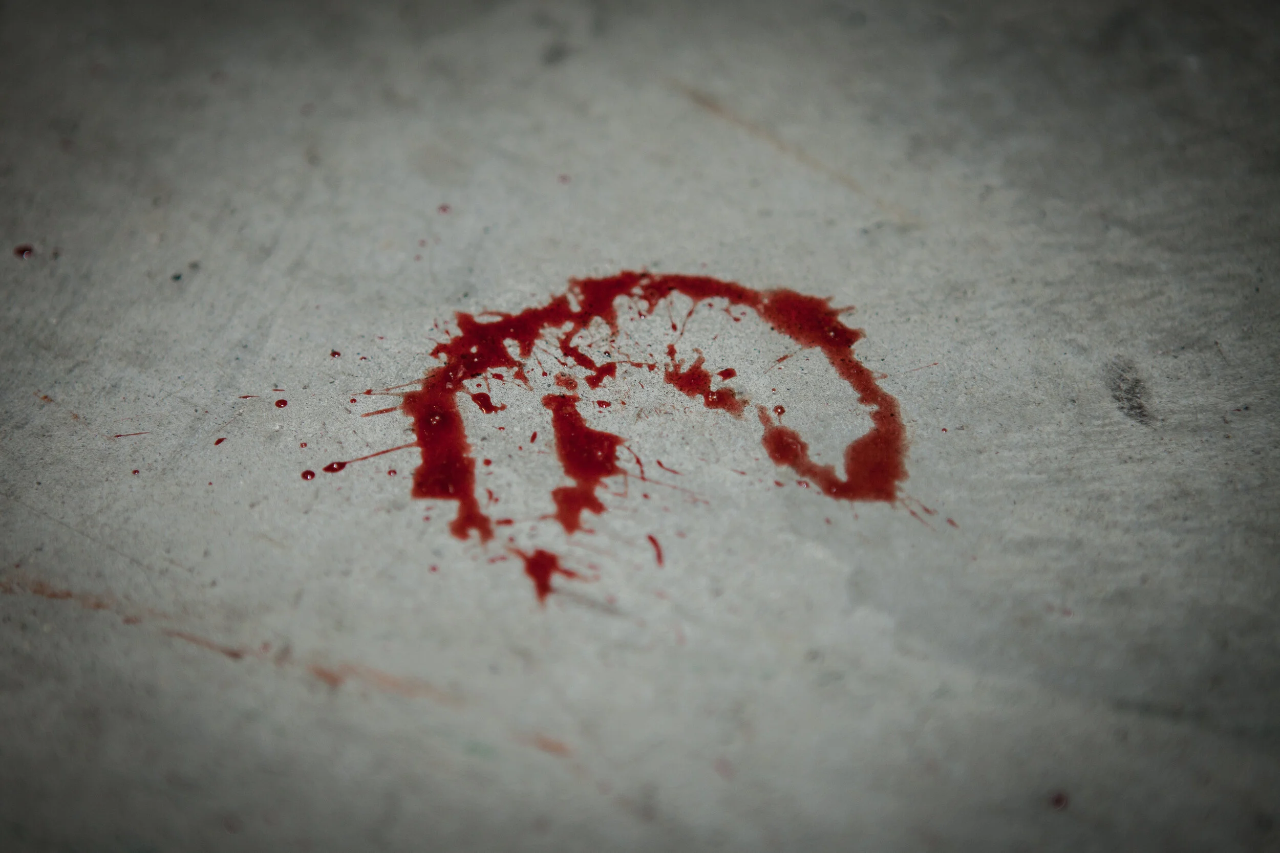  A mouthguard makes a mark following a fight. 