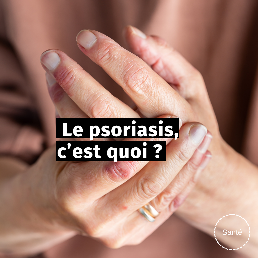 Le psoriasis, c’est quoi ?
