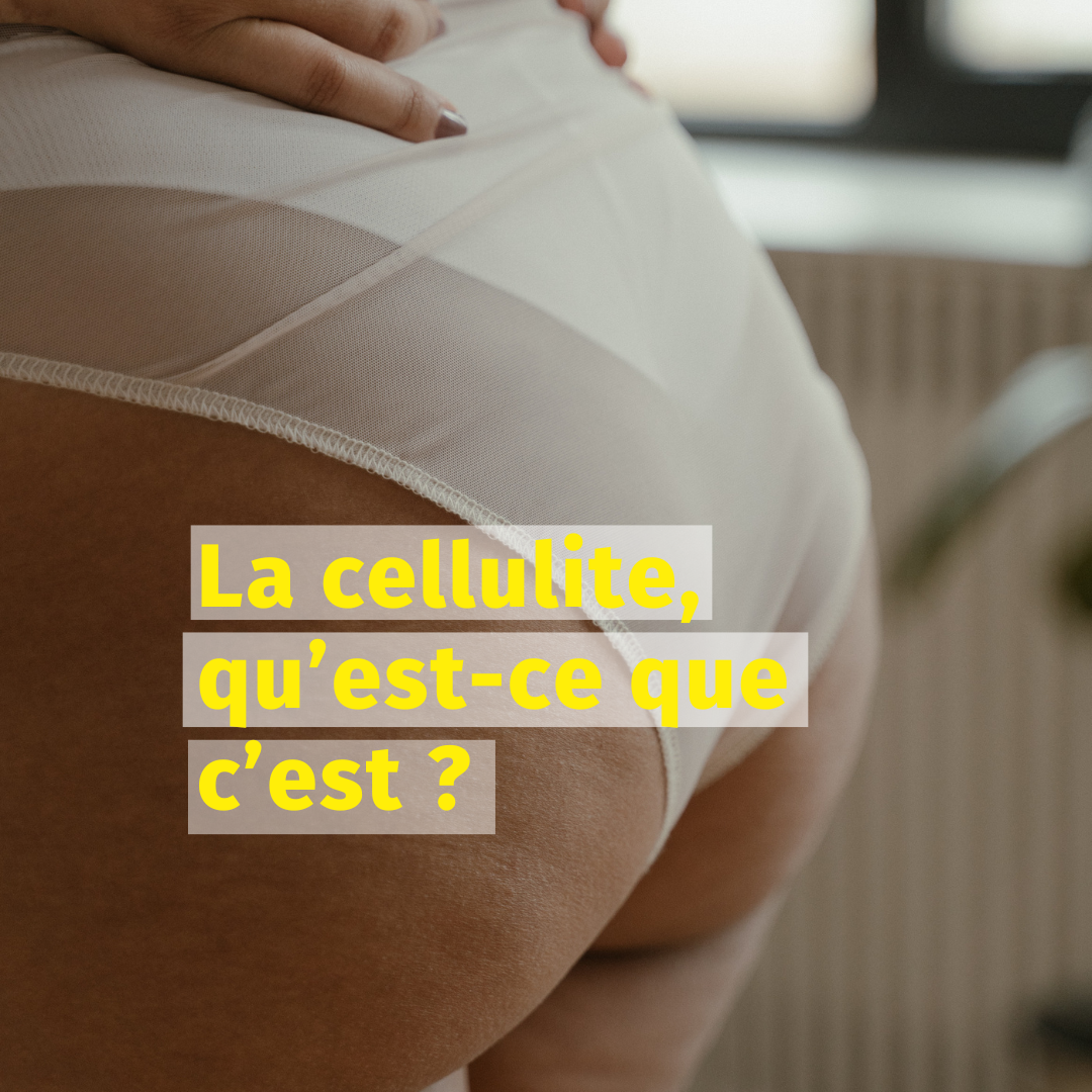 La cellulite, qu’est-ce que c’est ?