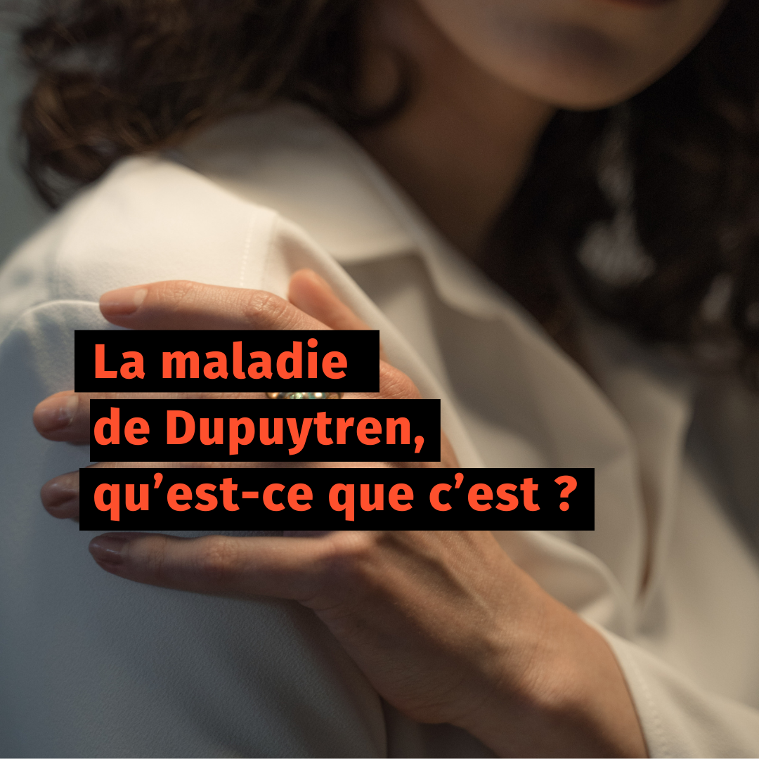 La maladie de Dupuytren, qu’est-ce que c’est ?