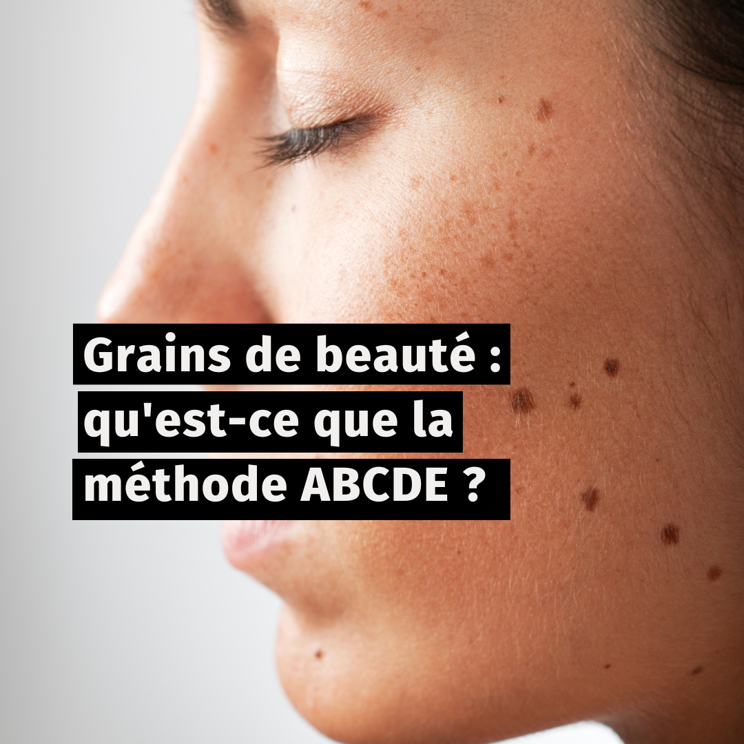 Grains de beauté : qu'est-ce que la méthode ABCDE ?