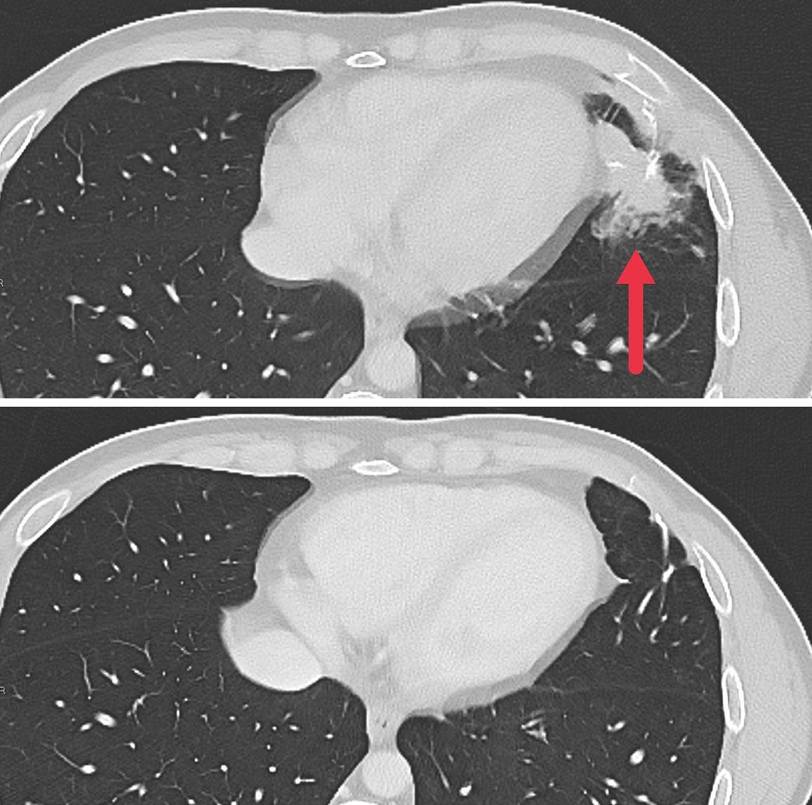 Tumor Shrinkage in Patients with Colorectal Cancers