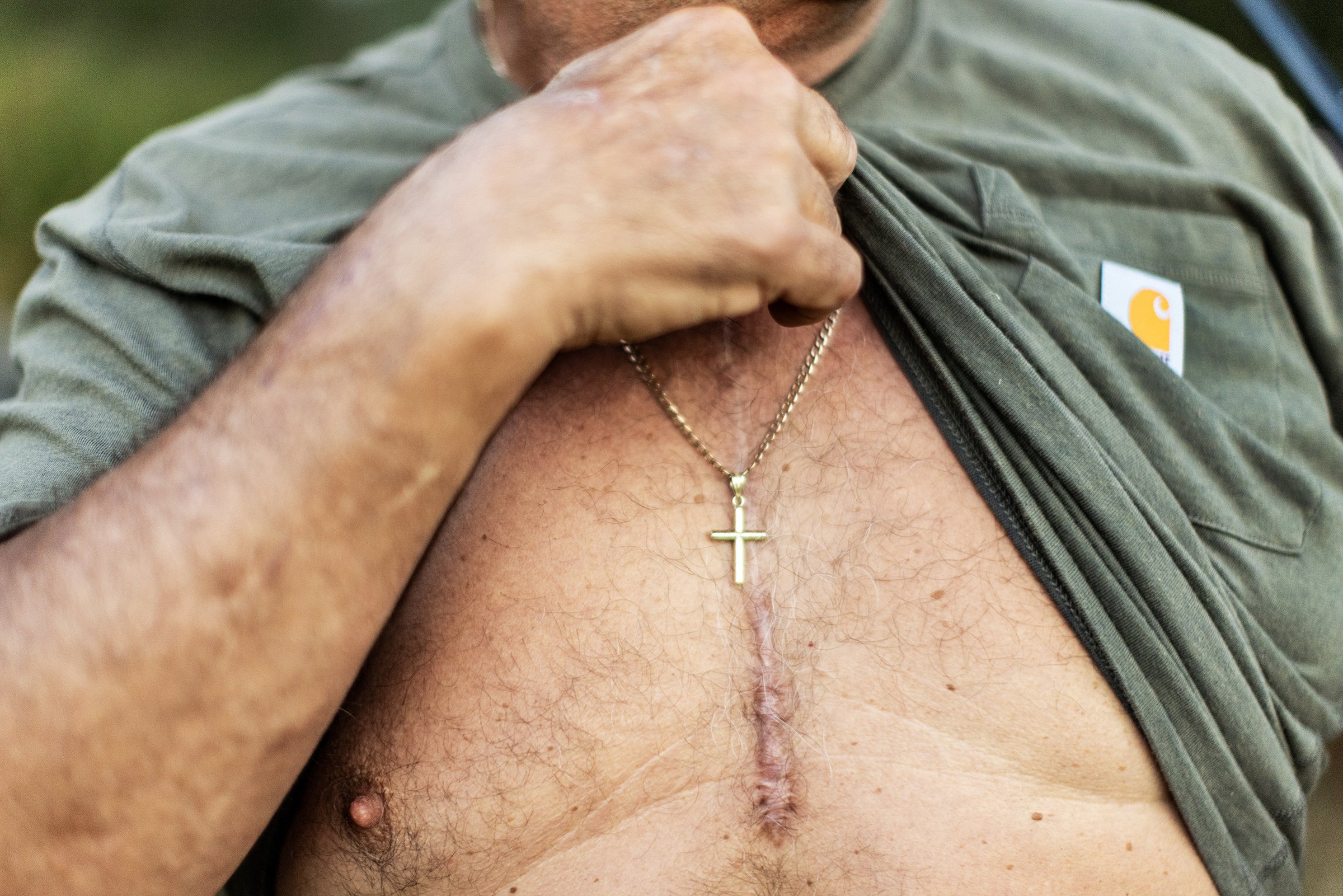  Jimmy McClellan, 65, shows off his scar from triple bypass surgery while hunting for doves in the Smith Point Hunting Club, near Gunnison, Mississippi on September 13, 2025. 