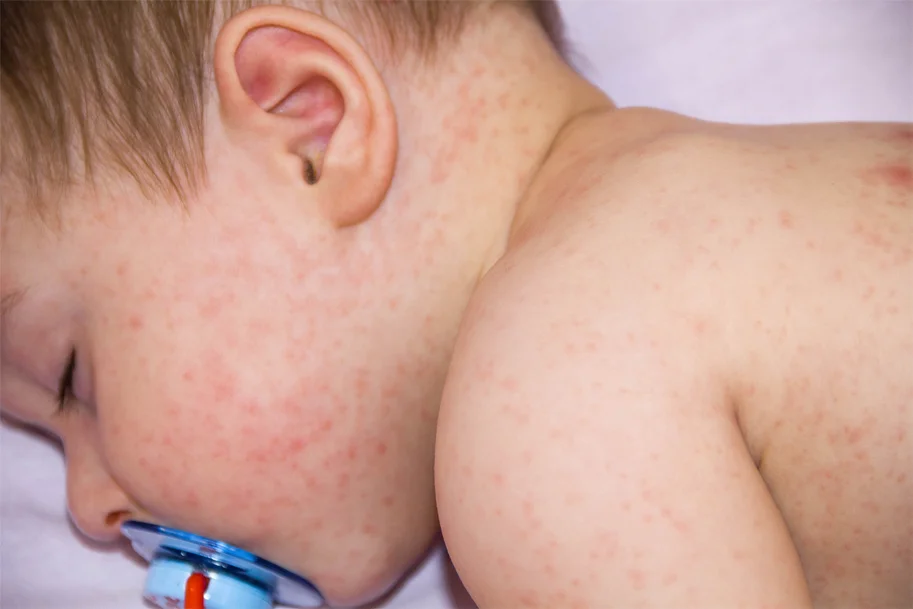 How-to-Prevent-Your-Baby-from-Developing-Allergies-During-Pregnancy-Baby-Allergies-Mriacle-Maker-Mom.jpg