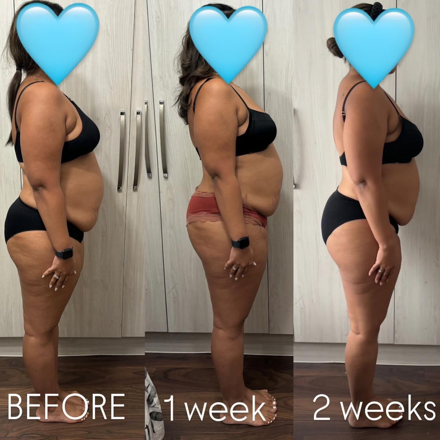 Cellulite is caused by fat deposits pushing through connective tissue beneath the skin - genetics and hormones also play a large role although diet can have a big impact. Hydrating with the correct quality water, sauna use and dry brushing are really