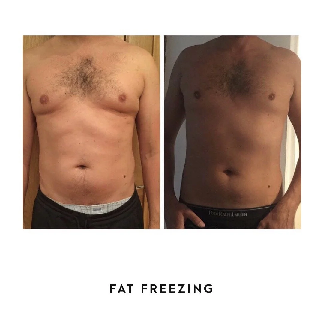 Fat freezing ireland