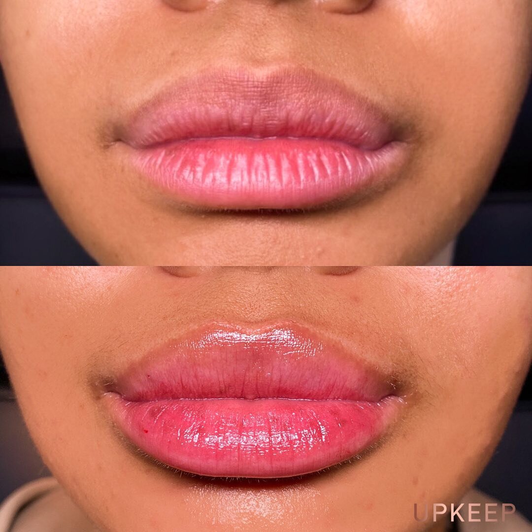 Picture perfect lips 💋

Injected by @lovelybylexi 

Message @upkeepmedapa, visit our website, or call the location of your choice to book 💕
Upper East Side (917) 675-7771
West Village: (646) 449-8288
Dallas: (214) 915-8442

This is a patient of Upk